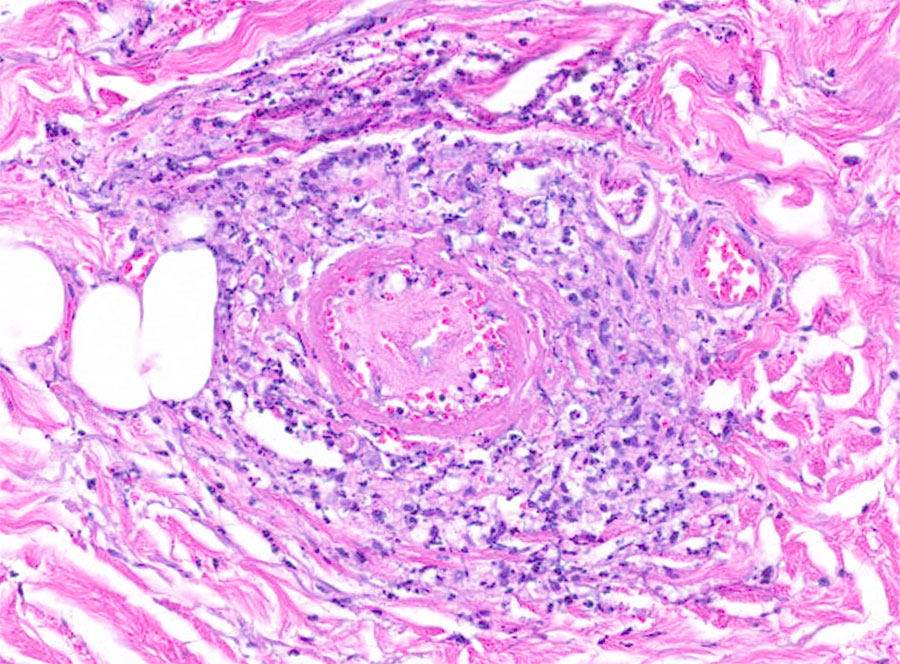 Periodic acid–Schiff positive histiocytoid cells from a patient with disseminated Acanthamoeba infection with necrotic skin lesions and granulomatous vasculitis. Magnification ×200. 