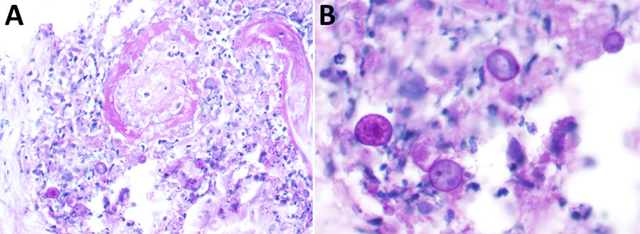 Periodic acid–Schiff positive histiocytoid cells from a patient with disseminated Acanthamoeba infection with necrotic skin lesions and granulomatous vasculitis. Cells are near the vessel with potential amoebic trophozoites. A) Magnification ×400; B) magnification ×600.