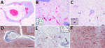 Histopathology (A–C) and in situ hybridization (D–F) of brain tissue from stranded Atlantic white-sided dolphin infected with novel tupavirus, Canada. Histopathology images are stained with hematoxylin and eosin; cytoplasm and connective tissues appear pink, red blood cells red, and cell nuclei purple. A) Cross-section through an arteriole within the neuropil at the level of the internal capsule, depicting sometimes massive infiltration of perivascular (Virchow-Robin) space by large numbers of lymphocytes and plasma cells, fewer numbers of macrophages, and rare eosinophils. Scale bar indicates 100 μm. B) Cross-section through the cingulate gyrus at the level of the internal capsule, showing almost complete effacement of normal neuropil architecture by massive numbers of hypertrophied microglial cells. Also depicted are multiple arterioles with large perivascular cuffs of lymphocytes and plasma cells, as well as multiple areas of hemorrhage within the neuropil. Inset shows microglial cells. Scale bar indicates 100 μm. C) Section through neocortex exhibiting extensive infiltration of the neuropil by glial cells, which frequently form nodules surrounding necrotic neurons. Necrotic neurons are shrunken with hypereosinophilic cytoplasm and condensed, pyknotic nuclei (arrows). There are also multiple small arterioles with lymphoplasmacytic perivascular cuffs. Inset shows a necrotic neuron. Scale bar indicates 50 μm. D) Abundant viral RNA (red staining) in the area surrounding the affected arteriole. Staining is observed in the neuropil as well as some glial cells; however, endothelial cells are not infected (inset). No staining is observed within the perivascular inflammatory cells. Scale bar indicates 400 μm. E) Viral RNA in microglial cells and neuropil (inset) but not within perivascular cuffs (arrow). Scale bar indicates 200 μm.) Abundant viral RNA within neurons and dendrites. In situ hybridization, paraffin-embedded formalin-fixed tissue sections were performed with RNAScope 2.5HD Detection Reagent and custom probes targeting the 1275–2283 nt region of the viral genome (Bio-Techne Advanced Cell Diagnostics, https://www.bio-techne.com). Scale bar indicates 200 μm.