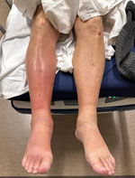 Lower extremities of patient in case 1 in report of Sphingobacterium hotanense infections in immunocompromised patients with skin and soft tissue infections, Minnesota, USA. Erythema and swelling of the right lower leg and foot are shown. No overt signs of abscess, necrosis, or purulence were noted at the time of examination.