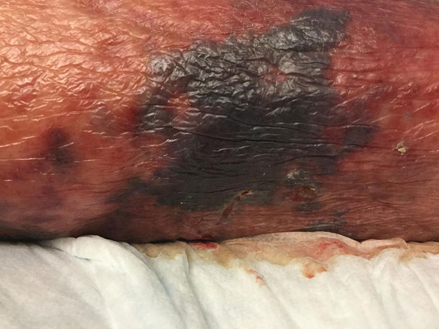 Right lower leg of patient in case 2 in report of Sphingobacterium hotanense infection in immunocompromised patients, Minnesota, USA, demonstrating extensive skin discoloration with surrounding erythema and increased drainage from wound (not visible).