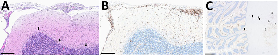 Neuropathologic autopsy findings from cerebellum of unvaccinated traveler from the United States who died of tickborne encephalitis, Switzerland, 2022. A) shows Extensive lymphocytic infiltrate involving both leptomeninges and cerebellar parenchyma with depletion of the Purkinje cell layer (arrows). Scale bar represents 300 μm. B) The infiltrate consisted predominantly of cluster of differentiation 3 + T cell lymphocytes. Scale bar represents 300 μm. C) Low magnification illustrates the diffuse and extensive nature of the infiltrate also involving the white matter with perivascular accentuation (black arrows) and the dentate nucleus (white arrows). Scale bar represents 3 mm. Hematoxylin and eosin staining.