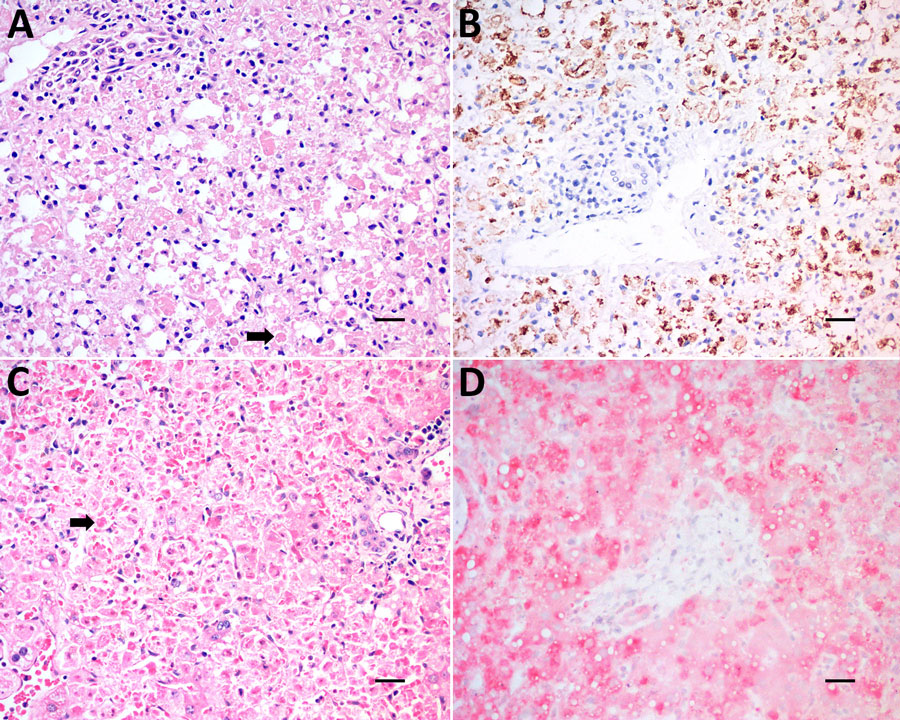 Laboratory analysis of liver samples from nonhuman primates collected for yellow fever virus (YFV) surveillance in Callithrix spp. marmosets during epizootic outbreak, Brazil, 2024–2025. A, B) Samples from Callicebus nigrifrons black fronted titi monkeys; C, D) samples from Alouatta caraya black howler monkeys. A) Hematoxylin and eosin stain of liver showing acute and severe hepatic damage characterized by diffusely individual cellular apoptosis and necrosis with Councilman–Rocha Lima bodies (arrow). B) Immunohistochemistry stain of hepatocytes; brown stain indicates cells positive for YFV antigen. C)  Immunohistochemistry stain showing acute and severe hepatic damage characterized by individual cellular apoptosis and necrosis with Councilman–Rocha Lima bodies (arrow); brown indicates hepatocytes positive by YFV antigen. D) Immunohistochemistry stain of hepatocytes positive for YFV antigen (red). Scale bars indicate 20 µm.