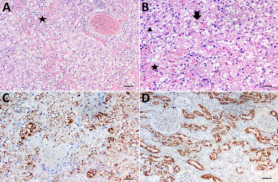 Laboratory analysis of organ samples collected from Callithrix penicillata marmosets with severe hepatic lesions due to yellow fever during epizootic yellow fever outbreak, Brazil, 2024–2025. A) Hematoxylin and eosin stain of liver showing acute and severe hepatic damage characterized by diffuse macrovesicular steatosis and focal hemorrhage (star). Original magnification ×10. B) Hematoxylin and eosin stain of liver showing acute and severe hepatic damage with macrovesicular steatosis (black arrowhead), focal hemorrhage (star), and a Councilman–Rocha Lima body (elongated arrow). Original magnification ×20. C) Immunohistochemisty stain showing hepatocytes positive for yellow fever virus antigen (brown staining). Original magnification ×20. D) Immunohistochemistry stain of renal tubular epithelial cells; brown stained cells are positive for yellow fever virus antigen. Original magnification ×10.