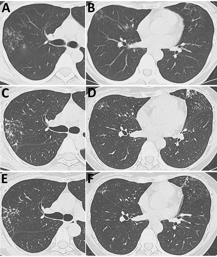 Serial axial chest computed tomography images over time from patient with Mycobacterium riyadhense pulmonary disease after relocation from Saudi Arabia, Japan. A, B) Images taken at initial hospital visit, demonstrating multiple scattered small nodular opacities in the right upper and middle lobes (A) and the lingular segment (B), accompanied by bronchial wall thickening. C, D) Images taken 2 years later, showing progression of the lesions in the right upper/middle lobes (C) and lingular segment (D). E, F) Images taken after treatment showing improvement of the lesions in the right upper/middle lobes (E) and lingular segment (F).