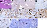 Histopathologic and immunohistochemical analyses of brain tissues and lymph nodes of camel prion disease–affected dromedary camels, Tunisia, 2019–2021. A) Examination of all available cerebral cortices (Appendix Table 3) showed mild spongiform changes exclusively in the temporal and occipital cortex of sample P81/16. B) Scrapie prion protein (PrPSc) immunostaining found in prefrontal cortex of sample P81/13. C) Magnification of the prefrontal cortex (dashed box in panel B) showing the involvement of the I and V–VI layers. D) Intraglial (inset) and intraneuronal PrPSc depositions observed in the thalamus in animal P81/9. E–I) PrPSc deposition patterns observed in camel prion disease–affected brain tissues: intraneuronal (E, arrows), perineuronal (F, arrows), glial associated (G, arrows), perivascular (H, arrows), punctate (I, arrows) and diffuse (I, asterisk) in the neuropil. J) Dense intra-astrocytic PrPSc deposition (arrows) observed in the medulla oblongata. K–L) PrPSc deposition, observed in primary and secondary follicles of lymph nodes, appear as a reticular network within the center of lymphoid follicles, accompanied by fine to coarse cytoplasmic granules in nonlymphoid cells. Representative immunostaining (arrows) of mandibular lymph node from animal P81/65 (K) and prescapular lymph node from animal P81/17 (L) highlights intense granular PrPSc depositions in tingible body macrophages within germinal centers. Brown indicates PrPSc deposition in brain sections; red indicates PrPSc deposition in lymph nodes. Scale bars indicate 50 µm in panels A and D, 100 µm in panel B, 250 µm in panel C, and 20 µm in panels E–L.