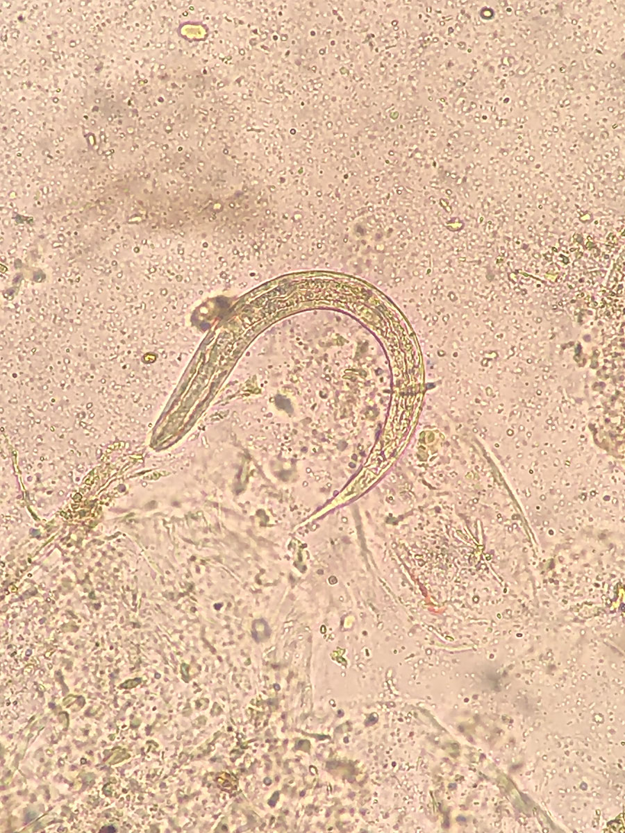 Strongyloides stercoralis L1 rhabditiform larva found in stool sample from recipient A in a study of donor screening failure for Strongyloides stercoralis in solid organ transplantation.
