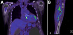 Positron emission tomography/computed tomography images from study of patient with Bartonella clarridgeiae prosthetic-valve endocarditis and aortic root abscess, Australia, 2020. A) Fluorodeoxyglucose activity at ventricular end of the transcatheter aortic valve implantation; B) repaired tibioperoneal trunk aneurysm in patient’s left leg.