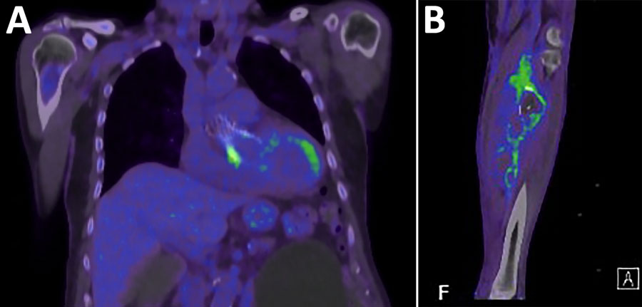 Positron emission tomography/computed tomography images from study of patient with Bartonella clarridgeiae prosthetic-valve endocarditis and aortic root abscess, Australia, 2020. A) Fluorodeoxyglucose activity at ventricular end of the transcatheter aortic valve implantation; B) repaired tibioperoneal trunk aneurysm in patient’s left leg.