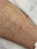 Diffuse skin lesions on donor’s leg in case of donor-derived West Nile virus infection in kidney transplant recipients, France, 2025. Lesions were suggestive of eruptive pseudo-angiomatosis associated with West Nile virus infection.