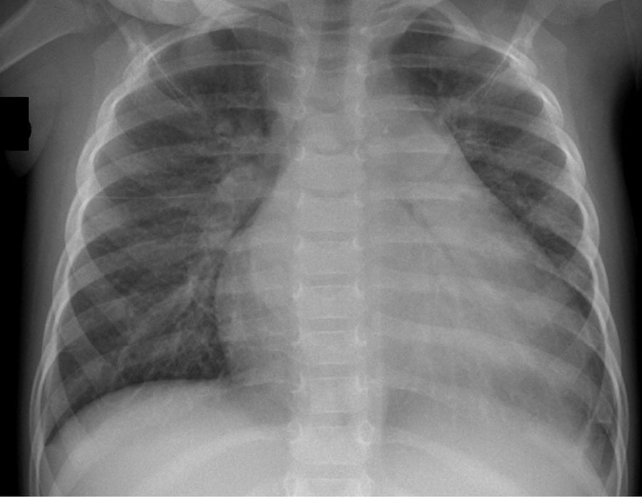 Chest magnetic resonance imaging of a pediatric patient with severe inflammatory cardiomyopathy caused by coxackievirus strain A9, northeastern France, 2024. Imaging was performed the day before admission to the pediatric ward and demonstrated unclear cardiomegaly.