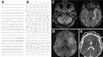 Electroencephalogram (EEG) and brain magnetic resonance imaging (MRI) testing of a patient with encephalitis caused by pigeon paramyxovirus type 1, France. A) The first EEG (day 5 after hospitalization) revealed nonspecific encephalopathy consisting of disorganized theta background rhythm and right temporal rhythmic delta focalization without seizure. B) A later EEG (day 23 after hospitalization) confirmed severe encephalitis with continuous, diffuse, nonreactive, high-amplitude, delta rhythm background of pseudo-periodic delta biphasic and triphasic waves, suggestive of cortical necrosis. C) MRI revealed diffuse bilateral fluid-attenuated inversion recovery hyperintensities, primarily cortical, with subcortical extensions, particularly to the temporal and insular regions, involving the pulvinar nuclei of the thalami, the basal ganglia, the internal capsule, the limbic system, and cerebellum. D, E) Hypersignals in diffusion-weighted images (D) and with reduced apparent diffusion coefficient (E) suggested diffuse cytotoxic brain edema in relation to severe necrotic encephalitis. 