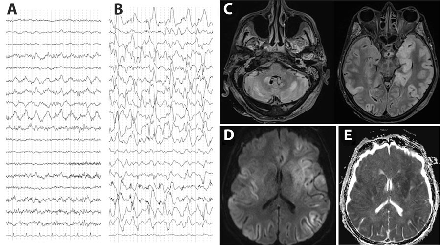 Electroencephalogram (EEG) and brain magnetic resonance imaging (MRI) testing of a patient with encephalitis caused by pigeon paramyxovirus type 1, France. A) The first EEG (day 5 after hospitalization) revealed nonspecific encephalopathy consisting of disorganized theta background rhythm and right temporal rhythmic delta focalization without seizure. B) A later EEG (day 23 after hospitalization) confirmed severe encephalitis with continuous, diffuse, nonreactive, high-amplitude, delta rhythm background of pseudo-periodic delta biphasic and triphasic waves, suggestive of cortical necrosis. C) MRI revealed diffuse bilateral fluid-attenuated inversion recovery hyperintensities, primarily cortical, with subcortical extensions, particularly to the temporal and insular regions, involving the pulvinar nuclei of the thalami, the basal ganglia, the internal capsule, the limbic system, and cerebellum. D, E) Hypersignals in diffusion-weighted images (D) and with reduced apparent diffusion coefficient (E) suggested diffuse cytotoxic brain edema in relation to severe necrotic encephalitis. 