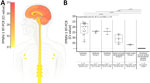 PPMV-1 dissemination in the central and peripheral nervous systems and in axillary lymph nodes in a patient with fatal PPMV-1 encephalitis in France. A) Schematic representation of PPMV-1 viral load in 30 postmortem tissue samples; complete list of all samples is provided (Appendix Table 3, https://wwwnc.cdc.gov/EID/article/32/5/25-1576-App1.pdf). Viral loads were estimated at 5.2 × 105−2.6 × 106 genome copies/gram of tissue in the midbrain and 1.1−5.5 × 105 genome copies/gram of tissue in the cervical spinal cord. B) PPMV-1 viral burden in different anatomic compartments. Samples were classified into 6 groups: group 1, forebrain (including telencephalon and diencephalon); group 2, midbrain; group 3, hindbrain (including metencephalon and myelencephalon); group 4, spinal cord and spinal ganglion; group 5, lymph nodes; group 6, peripheral nervous system and peripheral samples. For the 17 forebrain samples (group 1), the PPMV-1 Ct values were the lowest (median 19.76 [IQR 16.90–25.62]), reflecting the highest viral burden. A Ct value >30 was observed in only 2 forebrain samples, the choroid plexus (Ct = 32.2) and the pituitary gland (Ct = 33.85). The 3 midbrain samples (group 2) and the 2 hindbrain samples (group 3) had higher Ct values: medians 24.05 (IQR 23.77–25.63) and 24.17 (IQR 21.33–27.00). Ct value further increased in the subsequent groups: medians 30.91 (IQR 27.49–34.39) in the 4 spinal cord and 2 spinal ganglion samples (group 4) and 36.49 (IQR 36.06–36.92) in the 2 axillary lymph node samples (group 5), indicating a progressive decrease in viral burden. The last group, consisting of 17 samples (group 6) including peripheral nervous system samples and 5 peripheral samples were all negative. We conducted a nonparametric Kruskal-Wallis test that indicated differences among groups (p<0.0001). Posthoc tests revealed an increasing trend in PPMV-1 Ct value from the brain to the peripheral samples. Pairwise Wilcoxon tests (2-tailed) for differences in means between groups adjusted with Bonferroni correction are displayed. Nonsignificant p values (>0.05) are not shown. Horizontal line within boxes indicate medians, box tops and bottoms represent IQRs, and whiskers indicate minimum and maximum values. Ct, cycle threshold; IQR, interquartile range; PPMV-1, pigeon paramyxovirus type 1.