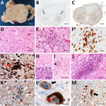 Histologic examination of the nervous tissue in fatal human encephalitis case caused by pigeon paramyxovirus type 1, France. A) Brown discoloration of the anterior horns (gray arrows) of the spinal cord at macroscopic examination. We evaluated the tissue microscopically by using hematoxylin and eosin staining, which highlighted a diffuse inflammatory infiltrate consisting of activated macrophages and microglia in the anterior horns of the spinal cord (throughout its entire length), the brainstem (including medulla oblongata, pons and midbrain), the thalamus and the cerebellum. Scale bar = 2 mm. B) Anti-CD163 staining revealed marked infiltration of the anterior horns of the spinal cord by activated macrophages (gray arrows). Scale bar = 1.5 mm. C) Anti-Iba1 staining revealed activated microglia involving the anterior horns and the lateral cords of the spinal cord. This inflammatory infiltrate was associated with severe neuronal loss, particularly in the anterior horns of the spinal cord and the dentate nucleus and the Purkinje cell layer of the cerebellum. Scale bar = 1.5 mm. D, E) H&E staining revealed massive loss of motor neurons of the anterior horn (D; scale bar = 50 µm) associated with foci of neuronophagia (E; scale bar = 25 µm). F) Anti-CD3 staining revealed microglial activation was associated with T-cytotoxic lymphocyte (CD3+/CD8+) infiltration of the brain parenchyma in the most severely affected regions, the T lymphocytes surrounding a motor neuron in the gray matter of the spinal cord. Scale bar = 25 µm. G) Anti-Iba1 staining revealed multiple foci of neuronophagia and microglial nodules were observed, indicating high activity of the cellular immune response involving mainly neurons as seen in microglial nodule (red arrow) in the substantia nigra. Scale bar = 50 µm. H) H&E staining revealed that this inflammatory infiltrate was associated with severe neuronal loss, particularly in the Purkinje cell layer of the cerebellum. Scale bar = 50 µm. I) H&E staining revealed massive loss of Purkinje cells associated with Bergmann astrogliosis in the cerebellar corte and in the anterior horns of the spinal cord and the dentate nucleus, loss of neurons in the dentate nucleus of the cerebellum associated with the presence of microglial nodules (star). Scale bar = 50 µm. J) H&E staining revealed a subtle lymphocytic infiltrate surrounding some of the vessels and a perivascular lymphocytic inflammatory infiltrate of the endoneurium of peripheral nerves. Scale bar = 50 µm. K–M) Anti-NVD staining revealed positivity in a microglial nodule in the anterior horn of the spinal cord (K), in the soma (black arrow) and in the nucleus (red arrow) of neurons in the substantia nigra (L), and (in the soma of a neuron (black arrow) and in neurites (red arrowheads) in the dentate nucleus of the cerebellum M). Scale bars = 25 µm). No cytopathic effects were noted. Immunohistochemistry testing with for herpes simplex virus 1, cytomegalovirus, polyomavirus, papovavirus, and rabies virus were negative. H&E, hematoxylin and eosin.