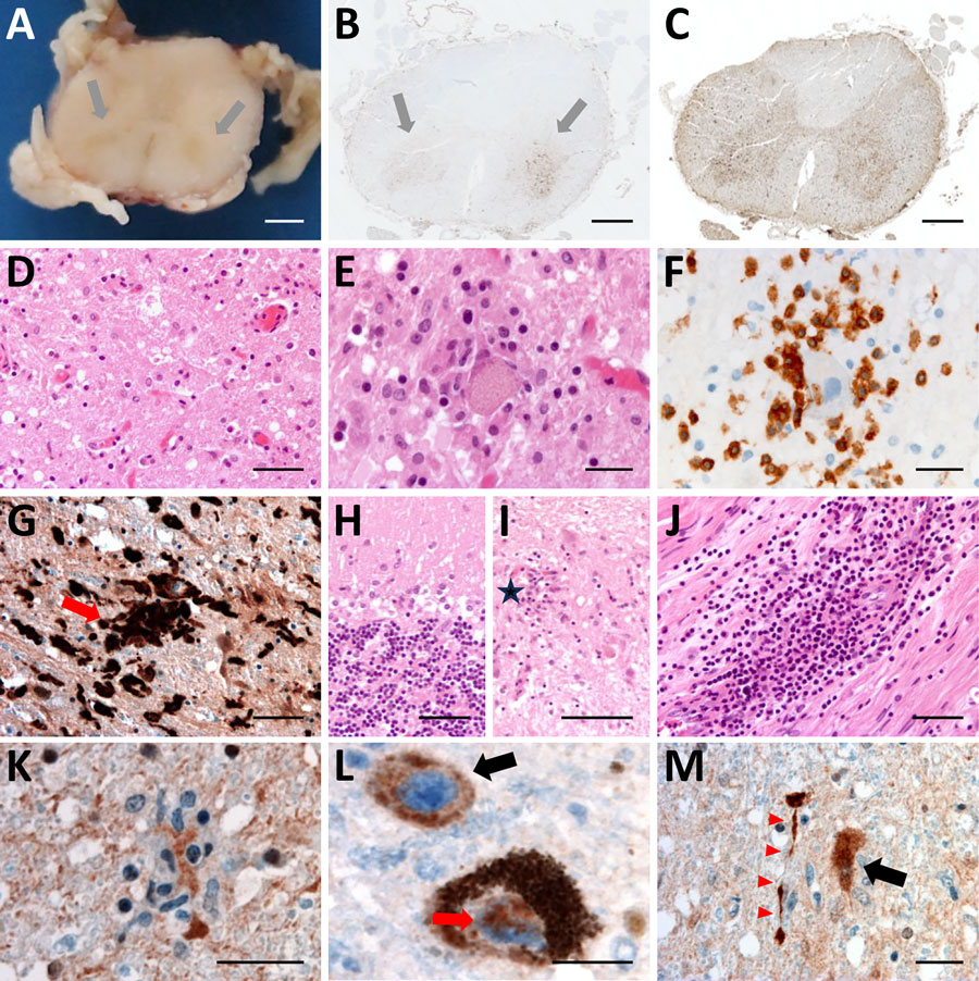 Histologic examination of the nervous tissue in fatal human encephalitis case caused by pigeon paramyxovirus type 1, France. A) Brown discoloration of the anterior horns (gray arrows) of the spinal cord at macroscopic examination. We evaluated the tissue microscopically by using hematoxylin and eosin staining, which highlighted a diffuse inflammatory infiltrate consisting of activated macrophages and microglia in the anterior horns of the spinal cord (throughout its entire length), the brainstem (including medulla oblongata, pons and midbrain), the thalamus and the cerebellum. Scale bar = 2 mm. B) Anti-CD163 staining revealed marked infiltration of the anterior horns of the spinal cord by activated macrophages (gray arrows). Scale bar = 1.5 mm. C) Anti-Iba1 staining revealed activated microglia involving the anterior horns and the lateral cords of the spinal cord. This inflammatory infiltrate was associated with severe neuronal loss, particularly in the anterior horns of the spinal cord and the dentate nucleus and the Purkinje cell layer of the cerebellum. Scale bar = 1.5 mm. D, E) H&E staining revealed massive loss of motor neurons of the anterior horn (D; scale bar = 50 µm) associated with foci of neuronophagia (E; scale bar = 25 µm). F) Anti-CD3 staining revealed microglial activation was associated with T-cytotoxic lymphocyte (CD3+/CD8+) infiltration of the brain parenchyma in the most severely affected regions, the T lymphocytes surrounding a motor neuron in the gray matter of the spinal cord. Scale bar = 25 µm. G) Anti-Iba1 staining revealed multiple foci of neuronophagia and microglial nodules were observed, indicating high activity of the cellular immune response involving mainly neurons as seen in microglial nodule (red arrow) in the substantia nigra. Scale bar = 50 µm. H) H&E staining revealed that this inflammatory infiltrate was associated with severe neuronal loss, particularly in the Purkinje cell layer of the cerebellum. Scale bar = 50 µm. I) H&E staining revealed massive loss of Purkinje cells associated with Bergmann astrogliosis in the cerebellar corte and in the anterior horns of the spinal cord and the dentate nucleus, loss of neurons in the dentate nucleus of the cerebellum associated with the presence of microglial nodules (star). Scale bar = 50 µm. J) H&E staining revealed a subtle lymphocytic infiltrate surrounding some of the vessels and a perivascular lymphocytic inflammatory infiltrate of the endoneurium of peripheral nerves. Scale bar = 50 µm. K–M) Anti-NVD staining revealed positivity in a microglial nodule in the anterior horn of the spinal cord (K), in the soma (black arrow) and in the nucleus (red arrow) of neurons in the substantia nigra (L), and (in the soma of a neuron (black arrow) and in neurites (red arrowheads) in the dentate nucleus of the cerebellum M). Scale bars = 25 µm). No cytopathic effects were noted. Immunohistochemistry testing with for herpes simplex virus 1, cytomegalovirus, polyomavirus, papovavirus, and rabies virus were negative. H&E, hematoxylin and eosin.
