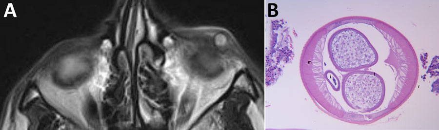 Images from patient with ocular dirofilariasis caused by Dirofilaria repens in California, USA. A) Axial plane of T-2–weighted orbital magnetic resonance imaging revealing a well circumscribed cystic lesion in the left lower eyelid. The center of the lesion is hyperintense and circumscribed by a hypointense signal. The interpretation was a benign inflammatory lesion. B) Histopathologic image from hematoxylin and eosin–stained slide that reveals a 500-micron diameter cross section of a nematode with a thick cuticular wall featuring external cuticular ridges (indicated by r) and vertically oriented muscle (indicated by m) extending toward the internal cavity (coelomyarian) that are numerous per quadrant (polymyarian), as well as paired reproductive tubes (indicated by t), and simple intestine (indicated by i).