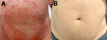 Skin lesions in case of Trichophyton indotineae dermatophytosis, Singapore, 2025. A) Before treatment; B) after 6 weeks of anidulafungin and itraconazole.