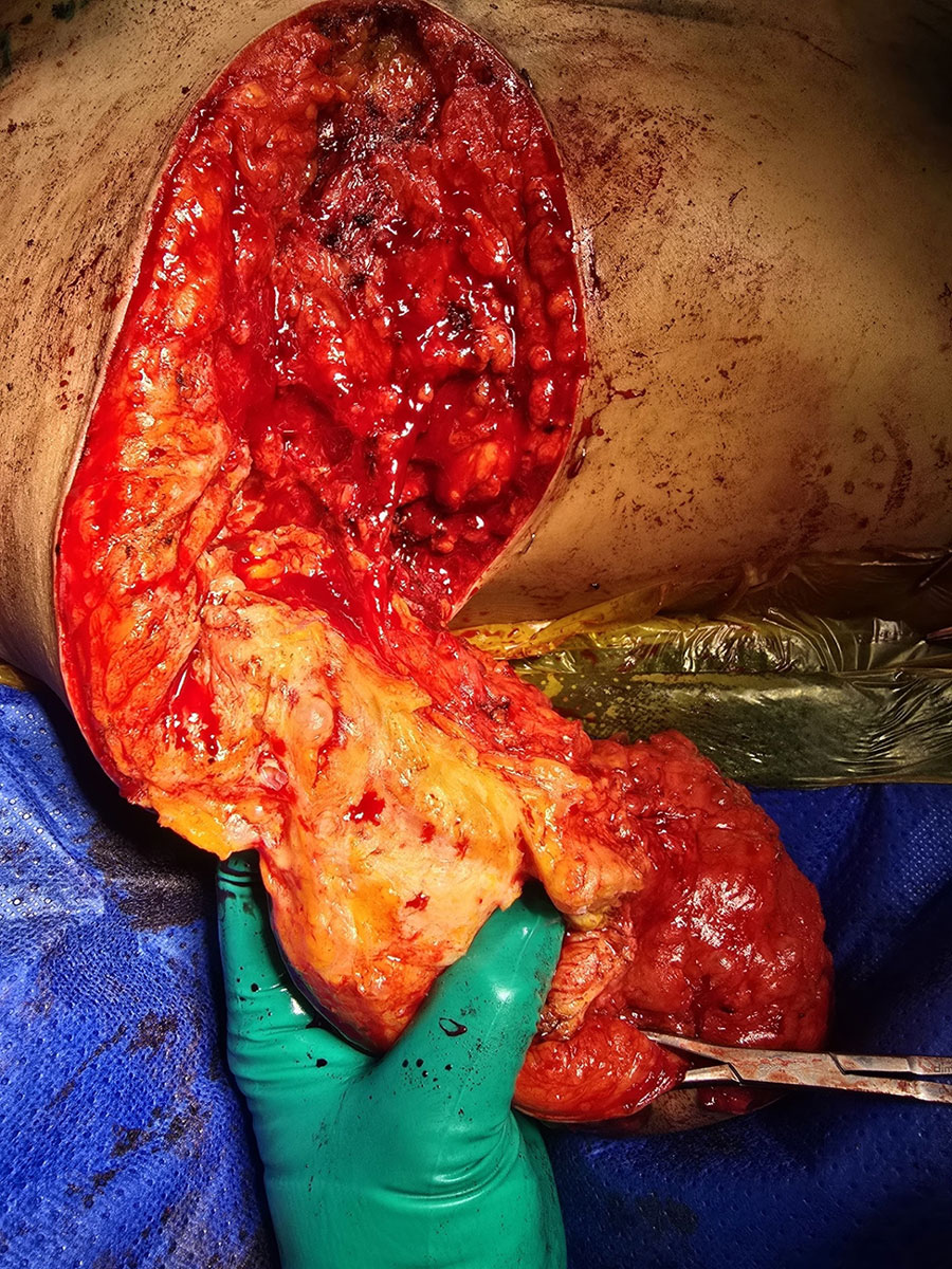 Intraoperative image from a case report of Cutibacterium avidum in post-mastectomy breast with prior silicone injections, Singapore. Image taken during an ongoing right breast reduction, depicting multiple loculations of foreign body embedded in the breast tissue.