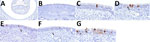 Distribution of influenza A virus nucleoprotein (NP) antigen in the nasal turbinates of pigs in study of systemic distribution and protracted detection of highly pathogenic avian influenza A(H5N1) clade 2.3.4.4b genotype D1.2 virus in swine after experimental inoculation. At 5 days postinoculation, NP antigen (brown) was commonly detected within the epithelial layer without (panel A; animal no. 648; original magnification ×40, inset ×200) and with (panel B; animal no. 642; original magnification ×200) notable loss of cilia of the turbinates, including the nucleus and cytoplasm of ciliated cells (panel C; animal no. 645; original magnification ×600) and less commonly nonciliated cells (panel D, arrowhead; animal no. 648; original magnification ×600). NP was also occasionally found within cells in the submucosa (panels E, F, arrowheads; animal nos. 641 and 648; original magnification ×600) and, rarely, at the cytoplasmic border of an aggregate of cells within the epithelium (panel G; animal no. 648; original magnification ×600).