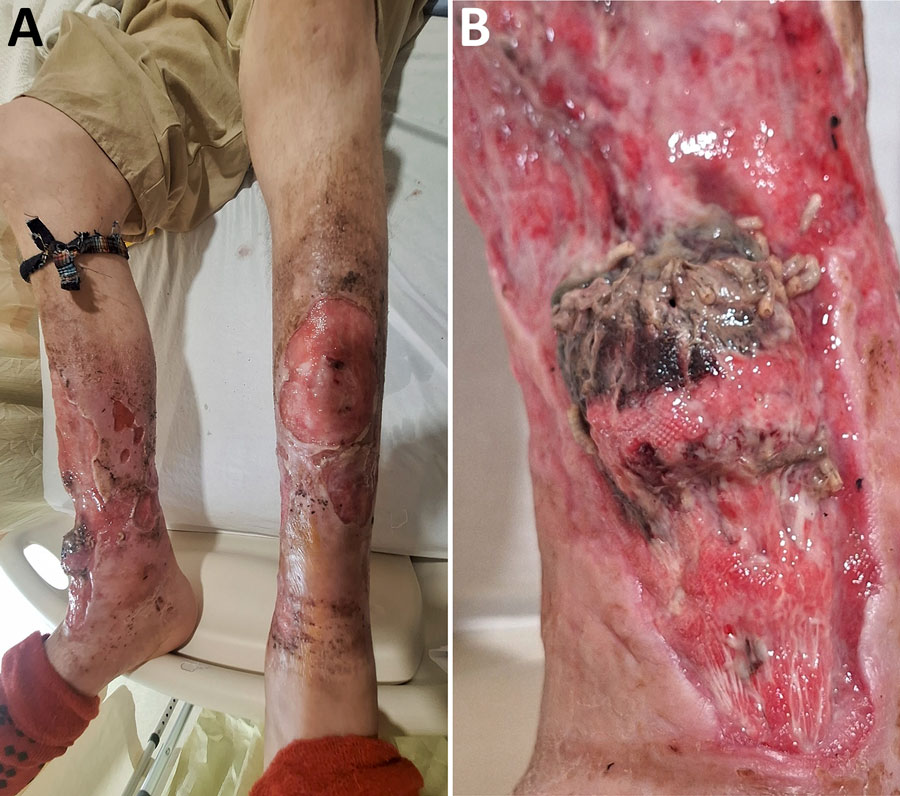 Leg wounds in case-patient 1 in pair of Ignatzschineria spp. bacteremia cases in persons experiencing homelessness, Vancouver, British Columbia, Canada, 2025. A) Bilateral leg wounds at time of admission; B) close-up of myiasis in exposed right tibialis anterior tendon.