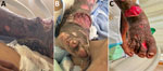 Leg wounds in case-patient 2 in pair of Ignatzschineria spp. bacteremia cases in persons experiencing homelessness, Vancouver, British Columbia, Canada, 2025. A, B) Lateral (A) and anterior (B) right leg wounds with visible myiasis at time of. C) Same wounds after 3 weeks of antibiotics and regular wound care.
