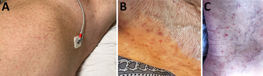 Rash lesions on a patient with Rickettsia lanei rickettsiosis, Oregon, USA. A) Pink blanching macules involving the trunk. B, C) Scattered petechiae on the lateral aspect of the foot (B) and posterior aspect of the ankle (C).