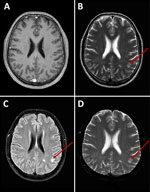 Axial brain magnetic resonance imaging of a patient with Chlamydia psittaci meningitis, Chile, 2023. A) T1-weighted image shows unremarkable appearance. B) T2-weighted image; C) fluid-attenuated inversion recovery image; and D) diffusion-weighted image show bilateral white matter hyperintensities (arrows).