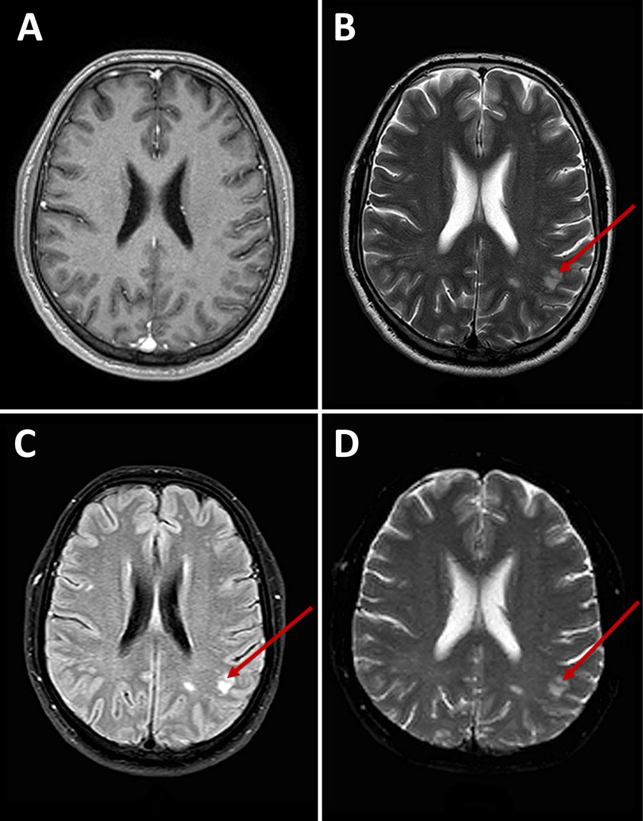 Axial brain magnetic resonance imaging of a patient with Chlamydia psittaci meningitis, Chile, 2023. A) T1-weighted image shows unremarkable appearance. B) T2-weighted image; C) fluid-attenuated inversion recovery image; and D) diffusion-weighted image show bilateral white matter hyperintensities (arrows).