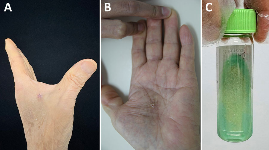 Novel cutaneous Mycobacterium infection in an 86-year-old man in China. A, B) Subcutaneous nodules on the left hand of the patient. C) Mycobacterium colonies grown on modified Löwenstein–Jensen medium slants.