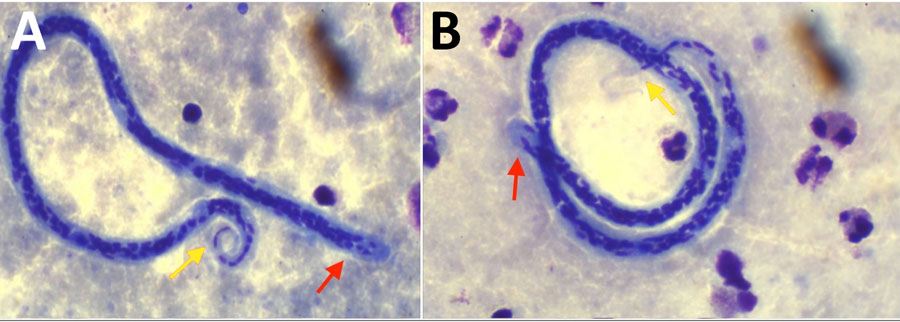 Microfilaria detected in Giemsa-stained thick blood smears from case-patients 1 (A) and 2 (B) in study of Dirofilaria infection and asymptomatic microfilaremia, Sri Lanka, 2025. Red arrows indicate the anterior end (cephalic space) with 2–3 distinct nuclei; yellow arrows indicate the tails free of any nuclei. Original magnification ×1,000.
