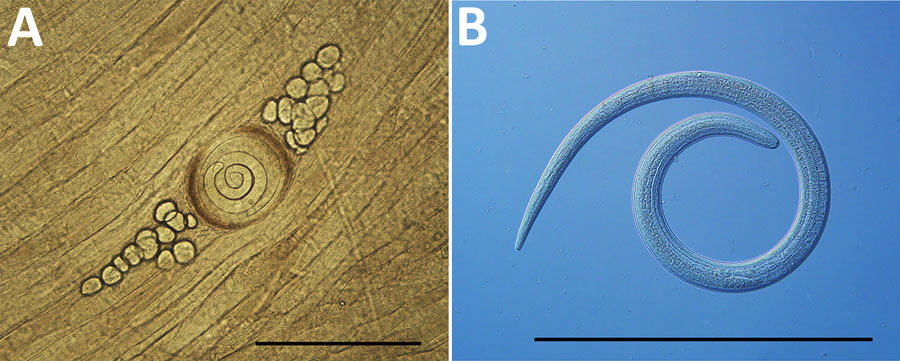 Trichinella spiralis larva from contaminated bear meat recovered from investigation into trichinellosis outbreak in North Carolina, USA, 2024. A) Encapsulated T. spiralis larva in squash prep of bear meat. B) Liberated T. spiralis larva after artificial pepsin-hydrochloric acid digestion shown under differential interference contrast. Scale bars equal 500 µm.