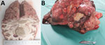 Necropsy brain and liver tissue from a case of neurologic alveolar echinococcosis in postpartum zoo-housed gorilla, the Netherlands, 2024. A) Cut surface of the cerebrum. Right hemisphere contains a 3.5-cm diameter, space-occupying tissue mass with ill-defined borders and secondary dislocation of preexisting structures. B) Surface of the liver. The parenchyma is largely replaced by multiple variably sized confluent nodules.