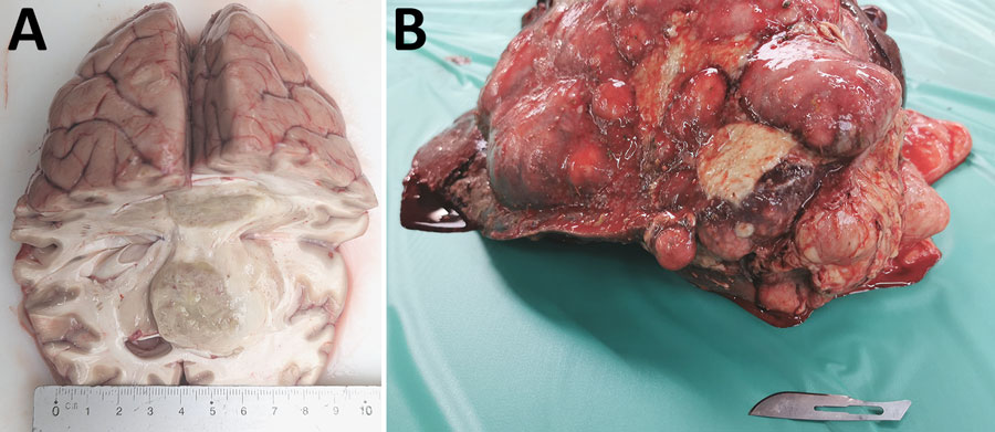 Necropsy brain and liver tissue from a case of neurologic alveolar echinococcosis in postpartum zoo-housed gorilla, the Netherlands, 2024. A) Cut surface of the cerebrum. Right hemisphere contains a 3.5-cm diameter, space-occupying tissue mass with ill-defined borders and secondary dislocation of preexisting structures. B) Surface of the liver. The parenchyma is largely replaced by multiple variably sized confluent nodules.
