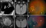 Imaging findings for ventriculomegaly and chorioretinitis associated with congenital lymphocytic choriomeningitis virus infection, Philadelphia, Pennsylvania, USA. A–C) Case 1; D–F) case 2. A) Routine ultrasonography at 36 weeks’ gestation, demonstrating severe cerebral ventriculomegaly in the fetus (black space between markers on the anatomic right and the unmarked black space on the anatomic left). B) Postnatal (38 weeks 4 days’ gestation) brain magnetic resonance imaging of newborn confirmed severe cerebral ventriculomegaly (large, white, fluid-filled spaces bilaterally and in the center of the image). C) Fundoscopic examination of newborn, revealing multiple areas of chorioretinitis (arrows). D) Routine ultrasonography at 36 weeks’ gestation, demonstrating severe cerebral ventriculomegaly in the fetus. E) Postnatal (38 weeks 5 days’ gestation) brain magnetic resonance imaging of newborn confirmed severe cerebral ventriculomegaly. F) Fundoscopic examination of newborn, revealing a large area of chorioretinitis (arrow).
