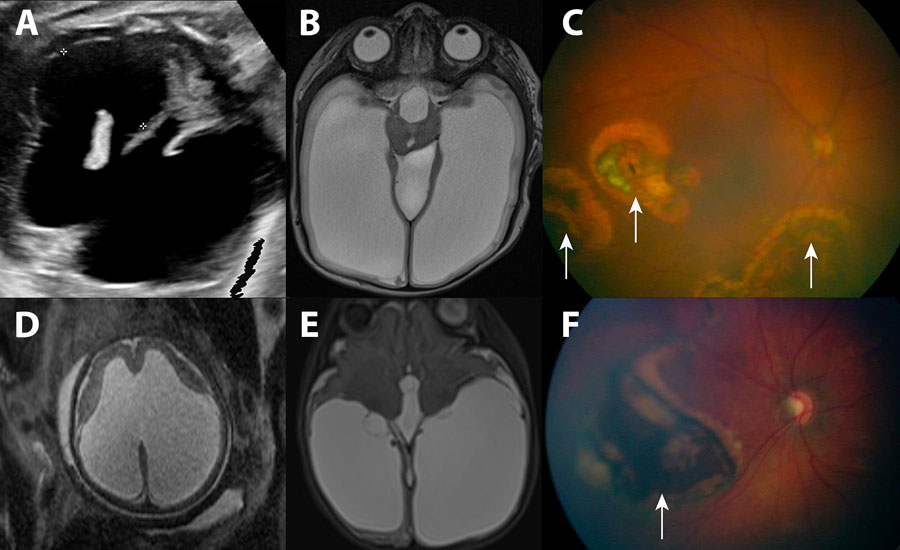Imaging findings for ventriculomegaly and chorioretinitis associated with congenital lymphocytic choriomeningitis virus infection, Philadelphia, Pennsylvania, USA. A–C) Case 1; D–F) case 2. A) Routine ultrasonography at 36 weeks’ gestation, demonstrating severe cerebral ventriculomegaly in the fetus (black space between markers on the anatomic right and the unmarked black space on the anatomic left). B) Postnatal (38 weeks 4 days’ gestation) brain magnetic resonance imaging of newborn confirmed severe cerebral ventriculomegaly (large, white, fluid-filled spaces bilaterally and in the center of the image). C) Fundoscopic examination of newborn, revealing multiple areas of chorioretinitis (arrows). D) Routine ultrasonography at 36 weeks’ gestation, demonstrating severe cerebral ventriculomegaly in the fetus. E) Postnatal (38 weeks 5 days’ gestation) brain magnetic resonance imaging of newborn confirmed severe cerebral ventriculomegaly. F) Fundoscopic examination of newborn, revealing a large area of chorioretinitis (arrow).