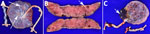 Pathologic findings of placental vascular anomalies associated with congenital lymphocytic choriomeningitis virus infection, Philadelphia, Pennsylvania, USA. A, B) Placenta from case 1; C) placenta from case 2. A) Gross pathology of the fetal surface showing yellow-white subchorionic intervillous thrombi (arrows). B) Cross sections of the placenta showing a subchorionic intervillous thrombus (arrow) and a peripheral intraparenchymal thrombus (white dashed circle). C) Gross pathology of the fetal surface of placenta with marginal insertion of three vessel umbilical cord and acute subamniotic hemorrhage (arrow). No additional gross lesions were identified after serial sectioning.