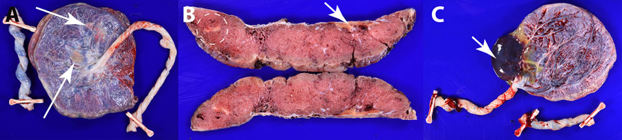 Pathologic findings of placental vascular anomalies associated with congenital lymphocytic choriomeningitis virus infection, Philadelphia, Pennsylvania, USA. A, B) Placenta from case 1; C) placenta from case 2. A) Gross pathology of the fetal surface showing yellow-white subchorionic intervillous thrombi (arrows). B) Cross sections of the placenta showing a subchorionic intervillous thrombus (arrow) and a peripheral intraparenchymal thrombus (white dashed circle). C) Gross pathology of the fetal surface of placenta with marginal insertion of three vessel umbilical cord and acute subamniotic hemorrhage (arrow). No additional gross lesions were identified after serial sectioning.