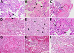 Microscopic findings for placental vascular pathology associated with congenital lymphocytic choriomeningitis virus infection, Philadelphia, Pennsylvania, USA. Hematoxylin and eosin–stained cross-sections of placenta from case 1 (A, B) and case 2 (C–I). A) Avascular villi surrounded by pink perivillous fibrin (asterisks) with scattered foci of rust-colored hemosiderin deposition (arrows) within the hyalinized stroma. Original magnification ×200. B) Cluster of avascular villi in the center of the image (asterisk) with scattered intravillous lymphocytes (arrows), compatible with chronic villitis. Original magnification ×200. C) Plasma cells (arrow) within the basal plate, consistent with chronic deciduitis. Original magnification ×200. D) Chronic villitis and perivillitis involving stem villi vessels (circle), with an associated avascular villus (asterisk) and fibrin deposition (arrow). Original magnification ×100. E) Chronic villitis (asterisk) with villous stromal vascular karyorrhexis; arrows point to examples of extravasated, fragmented erythrocytes and nuclear debris. Original magnification ×100. F) Histiocytic intervillositis (arrows) adjacent to avascular villi (asterisks) with perivillous fibrin deposition. Original magnification ×400. G–I) Avascular villi with associated perivillous fibrin deposition (dashed ellipses). G) Original magnification ×40; H, I) original magnification ×100. 