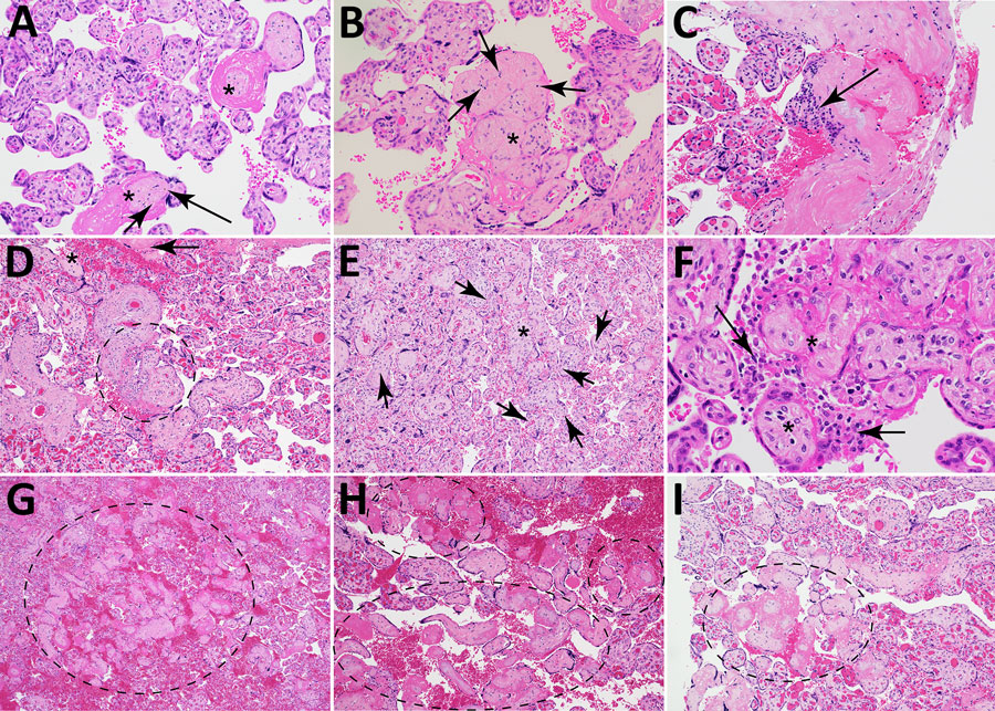 Microscopic findings for placental vascular pathology associated with congenital lymphocytic choriomeningitis virus infection, Philadelphia, Pennsylvania, USA. Hematoxylin and eosin–stained cross-sections of placenta from case 1 (A, B) and case 2 (C–I). A) Avascular villi surrounded by pink perivillous fibrin (asterisks) with scattered foci of rust-colored hemosiderin deposition (arrows) within the hyalinized stroma. Original magnification ×200. B) Cluster of avascular villi in the center of the image (asterisk) with scattered intravillous lymphocytes (arrows), compatible with chronic villitis. Original magnification ×200. C) Plasma cells (arrow) within the basal plate, consistent with chronic deciduitis. Original magnification ×200. D) Chronic villitis and perivillitis involving stem villi vessels (circle), with an associated avascular villus (asterisk) and fibrin deposition (arrow). Original magnification ×100. E) Chronic villitis (asterisk) with villous stromal vascular karyorrhexis; arrows point to examples of extravasated, fragmented erythrocytes and nuclear debris. Original magnification ×100. F) Histiocytic intervillositis (arrows) adjacent to avascular villi (asterisks) with perivillous fibrin deposition. Original magnification ×400. G–I) Avascular villi with associated perivillous fibrin deposition (dashed ellipses). G) Original magnification ×40; H, I) original magnification ×100. 