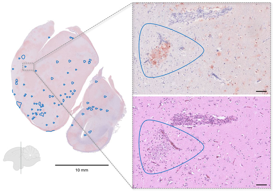 Representative histopathologic findings in influenza A(H5N1)֪–infected cranes from study of highly pathogenic avian influenza A(H5N1) clade 2.3.4.4b virus causing mass mortality in cranes, Germany, 2025. Immunohistochemistry of a coronal brain section at the level of the nidopallium demonstrating widespread viral antigen detection (brown staining) with only limited inflammatory and necrotic changes (blue outlines). Callout images at right show the corresponding region in consecutive sections, with abundant antigen-positive cells in immunohistochemistry (top) but only a small necrotic focus in the matching hematoxylin and eosin–stained section (bottom). Scale bars in callout images represent 50 μm. 
