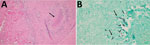 Images of stained tissue specimen from olecranon bursa of case-patient 1 in study of chronic elbow nodules caused by Fomitiporella fungus in immunocompetent patients, United States. A) Hematoxylin and eosin staining shows multiple large expansile back-to-back necrotizing granulomas surrounded by epithelioid histiocytes (arrow). Original magnification ×100. B) Grocott methenamine-silver staining shows many fungal hyphae visible throughout the granulomas (arrows). Original magnification ×400.