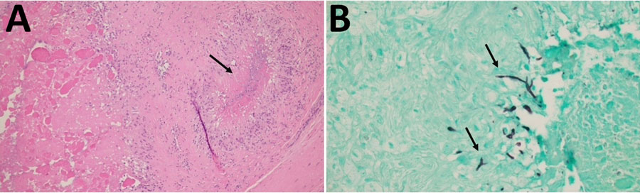 Images of stained tissue specimen from olecranon bursa of case-patient 1 in study of chronic elbow nodules caused by Fomitiporella fungus in immunocompetent patients, United States. A) Hematoxylin and eosin staining shows multiple large expansile back-to-back necrotizing granulomas surrounded by epithelioid histiocytes (arrow). Original magnification ×100. B) Grocott methenamine-silver staining shows many fungal hyphae visible throughout the granulomas (arrows). Original magnification ×400.