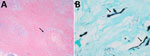 Images of stained tissue specimen from olecranon bursa of case-patient 2 in study of chronic elbow nodules caused by Fomitiporella fungus in immunocompetent patients, United States. A) Hematoxylin and eosin staining shows sclerotic granuloma (arrow). Original magnification ×20. B) Grocott methenamine-silver staining shows many fungal hyphae visible throughout the granulomas (arrows). Original magnification ×400.