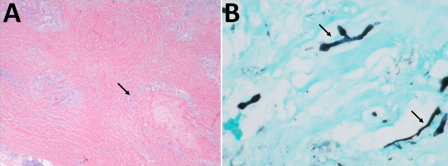 Images of stained tissue specimen from olecranon bursa of case-patient 2 in study of chronic elbow nodules caused by Fomitiporella fungus in immunocompetent patients, United States. A) Hematoxylin and eosin staining shows sclerotic granuloma (arrow). Original magnification ×20. B) Grocott methenamine-silver staining shows many fungal hyphae visible throughout the granulomas (arrows). Original magnification ×400.