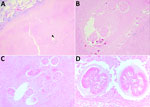 Dirofilaria organisms recovered from a patient with human pulmonary dirofilariasis in  North Queensland, Australia, 2023. A) Degenerate D. immitis nematode (black arrow) within a necrotic human lung granuloma and adjacent parenchyma. Original magnification ×2. B, C) Deeper cuts of the same region at 100× magnification. D) Cross-section of 2 regions of the coiled worm at 400× magnification. Hematoxylin and eosin stains.