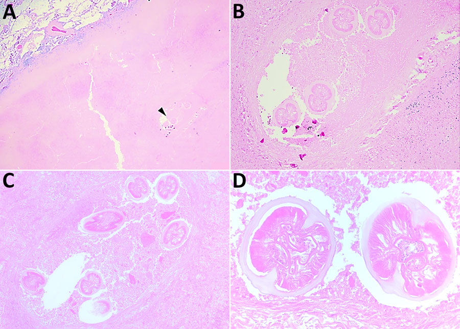 Dirofilaria organisms recovered from a patient with human pulmonary dirofilariasis in  North Queensland, Australia, 2023. A) Degenerate D. immitis nematode (black arrow) within a necrotic human lung granuloma and adjacent parenchyma. Original magnification ×2. B, C) Deeper cuts of the same region at 100× magnification. D) Cross-section of 2 regions of the coiled worm at 400× magnification. Hematoxylin and eosin stains.