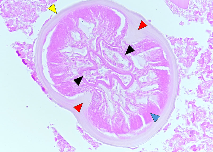 Defining anatomic features of Dirofilaria immitis within a small blood vessel (arteriole) in a necrotic human lung granuloma, recovered from a patient with human pulmonary dirofilariasis in Queensland, Australia, 2023. Yellow arrowhead indicates inflated necrotic smooth cuticle, without cuticular ridges; blue arrowhead indicates degenerate coelomyarian muscle structure; red arrows indicate inflated and necrotic internal cuticular ridges; and black arrows indicate degenerate paired uterine tubes. Hematoxylin and eosin stain; original magnification is ×600. 