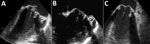 Transesophageal echocardiograph findings from a case of human Lactococcus garvieae bloodstream infection complicated by spondylodiscitis, Germany. A) Echocardiograph obtained on day 6 demonstrates mobile vegetations on both leaflets of the biological prosthetic mitral valve with a maximum dimension of 6 × 16 mm and pronounced valvular leaflet thickening (arrow). No notable valvular dysfunction was present. B) Echocardiograph obtained on day 45 shows marked regression of mitral valve leaflet thickening and a smaller vegetation (arrow; maximum 4 × 4 mm). No notable valvular dysfunction was present. C) Echocardiograph obtained on day 98 shows marked regression of mitral valve leaflet thickening. Arrow shows a faint 5 mm filamentous structure that might represent a residual finding. No notable valvular dysfunction was present.
