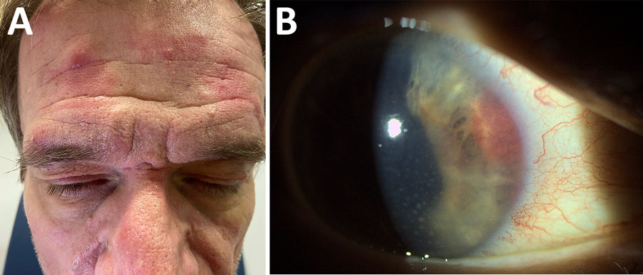 Clinical findings of a vascularized iris mass as sentinel manifestation of syphilis in patient with HIV infection, Spain, 2025. A) Maculopapular facial rash consistent with secondary syphilis. B) Slit-lamp photograph demonstrating a nonpigmented, vascularized iris base mass with conjunctival hyperemia, corneal edema, and mutton-fat keratic precipitates.